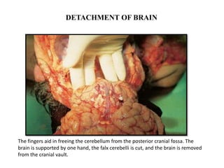 DETACHMENT OF BRAIN
The fingers aid in freeing the cerebellum from the posterior cranial fossa. The
brain is supported by one hand, the falx cerebelli is cut, and the brain is removed
from the cranial vault.
 