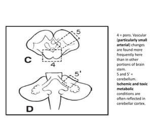 4 = pons. Vascular
(particularly small
arterial) changes
are found more
frequently here
than in other
portions of brain
stem.
5 and 5' =
cerebellum.
Ischemic and toxic
metabolic
conditions are
often reflected in
cerebellar cortex.
 