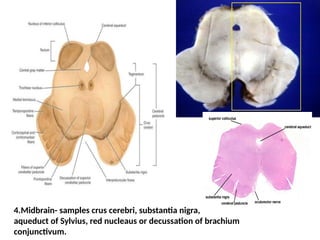 autopsy dissection of cns mail 2 Pathology | PPTX