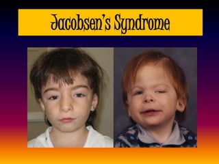 Jacobsen’s Syndrome
 