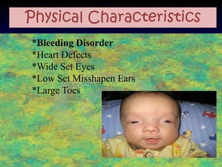 Physical Characteristics
*Bleeding Disorder
*Heart Defects
*Wide Set Eyes
*Low Set Misshapen Ears
*Large Toes
 