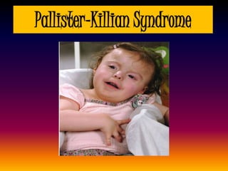Pallister-Killian Syndrome
 