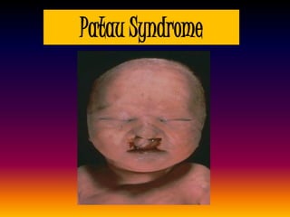 Patau Syndrome
 