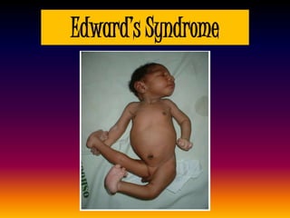 Edward’s Syndrome
 