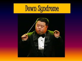 Down Syndrome
 