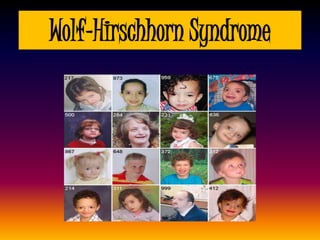 Wolf-Hirschhorn Syndrome
 