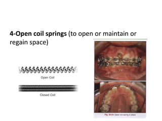 Spring Effect Attachments Invisalign Auxiliary attachment | PPTX