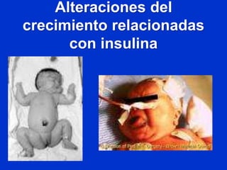 Alteraciones del
crecimiento relacionadas
con insulina
 