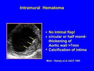 Aortic ulcer intramural hematoma aortic dissection | PPT