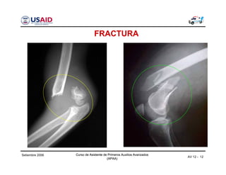 Curso de Asistente de Primeros Auxilios Avanzados
(APAA)
Curso de Asistente de Primeros Auxilios Avanzados
(APAA)
AV 12 - 12
Setiembre 2006 Curso de Asistente de Primeros Auxilios Avanzados
(APAA)
FRACTURA
 