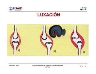 Curso de Asistente de Primeros Auxilios Avanzados
(APAA)
Curso de Asistente de Primeros Auxilios Avanzados
(APAA)
AV 12 - 17
Setiembre 2006 Curso de Asistente de Primeros Auxilios Avanzados
(APAA)
LUXACIÓN
 