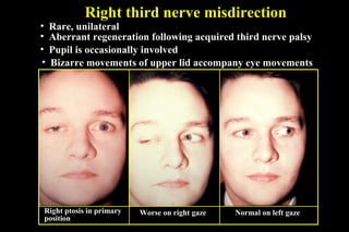 Right third nerve misdirection
• Rare, unilateral
• Aberrant regeneration following acquired third nerve palsy
• Pupil is occasionally involved
• Bizarre movements of upper lid accompany eye movements
Right ptosis in primary
position
Worse on right gaze Normal on left gaze
 