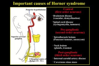 Important causes of Horner syndrome
Central
(first order neurone)
• Brainstem disease
(vascular, demyelination)
• Spinal cord disease
(syringomyelia, tumours)
Pre-ganglionic
(second order neurone)
• Intrathoracic lesions
(Pancoast tumour, aneurysm)
• Neck lesions
(glands, trauma)
Post-ganglionic
(third order neurone)
• Internal carotid artery disease
• Cavernous sinus mass
Posterior hypothalamus
Ciliospinal centre of
Budge( C8 - T2 )
Superior cervical
ganglion
 