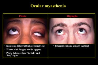 Ocular myasthenia
• Insidious, bilateral but asymmetrical
• Worse with fatigue and in upgaze
Ptosis
• Ptotic lid may show ‘twitch’ and
‘hop’ signs
• Intermittent and usually vertical
Diplopia
 
