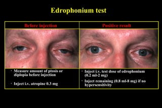 Edrophonium test
• Measure amount of ptosis or
diplopia before injection
• Inject i.v. atropine 0.3 mg
• Inject i.v. test dose of edrophonium
(0.2 ml-2 mg)
• Inject remaining (0.8 ml-8 mg) if no
hypersensitivity
Before injection Positive result
 