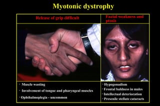 Myotonic dystrophy
Facial weakness and
ptosis
• Involvement of tongue and pharyngeal muscles
• Ophthalmoplegia - uncommon
• Muscle wasting • Hypogonadism
• Frontal baldness in males
• Intellectual deterioration
• Presenile stellate cataracts
Release of grip difficult
 