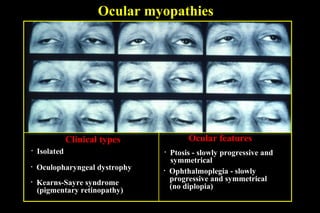 Ocular myopathies
• Isolated
• Oculopharyngeal dystrophy
• Kearns-Sayre syndrome
(pigmentary retinopathy)
• Ptosis - slowly progressive and
symmetrical
• Ophthalmoplegia - slowly
progressive and symmetrical
(no diplopia)
Clinical types Ocular features
 