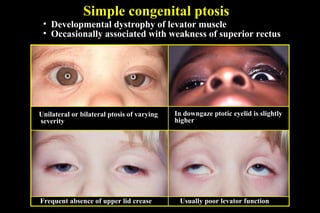 Simple congenital ptosis
• Developmental dystrophy of levator muscle
• Occasionally associated with weakness of superior rectus
Unilateral or bilateral ptosis of varying
severity
In downgaze ptotic eyelid is slightly
higher
Frequent absence of upper lid crease Usually poor levator function
 