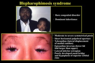Blepharophimosis syndrome
• Rare congenital disorder
• Dominant inheritance
• Moderate to severe symmetrical ptosis
• Short horizontal palpebral aperture
• Telecanthus (lateral displacement
of medial canthus)
• Epicanthus inversus (lower lid
fold larger than upper)
• Lateral inferior ectropion
• Poorly developed nasal bridge
and hypoplasia of superior orbital
rims
 