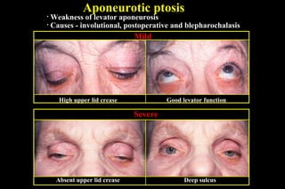 Aponeurotic ptosis
• Weakness of levator aponeurosis
• Causes - involutional, postoperative and blepharochalasis
High upper lid crease Good levator function
Absent upper lid crease Deep sulcus
Mild
Severe
 