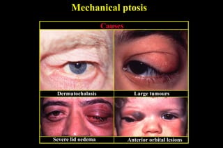 Mechanical ptosis
Causes
Dermatochalasis Large tumours
Severe lid oedema Anterior orbital lesions
 