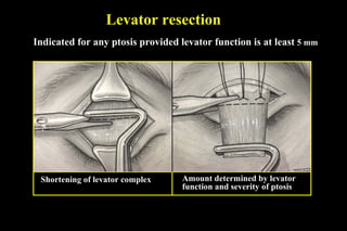 Levator resection
Shortening of levator complex
Indicated for any ptosis provided levator function is at least 5 mm
Amount determined by levator
function and severity of ptosis
 