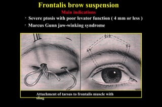 Frontalis brow suspension
Attachment of tarsus to frontalis muscle with
sling
Main indications
• Severe ptosis with poor levator function ( 4 mm or less )
• Marcus Gunn jaw-winking syndrome
 