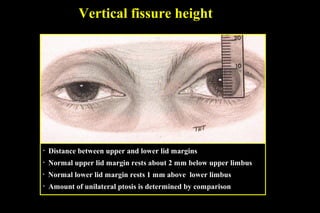 • Distance between upper and lower lid margins
• Normal upper lid margin rests about 2 mm below upper limbus
• Normal lower lid margin rests 1 mm above lower limbus
• Amount of unilateral ptosis is determined by comparison
Vertical fissure height
 