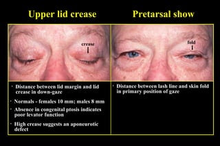 Upper lid crease
• Distance between lid margin and lid
crease in down-gaze
• Normals - females 10 mm; males 8 mm
• Absence in congenital ptosis indicates
poor levator function
• High crease suggests an aponeurotic
defect
• Distance between lash line and skin fold
in primary position of gaze
Pretarsal show
crease fold
 