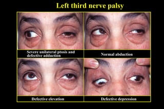 Left third nerve palsy
Severe unilateral ptosis and
defective adduction Normal abduction
Defective elevation Defective depression
 
