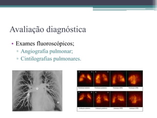Avaliação diagnóstica
• Exames fluoroscópicos;
▫ Angiografia pulmonar;
▫ Cintilografias pulmonares.
 