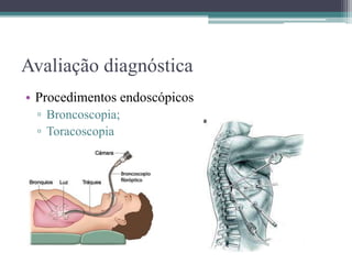 Avaliação diagnóstica
• Procedimentos endoscópicos
▫ Broncoscopia;
▫ Toracoscopia
 