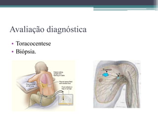Avaliação diagnóstica
• Toracocentese
• Biópsia.
 