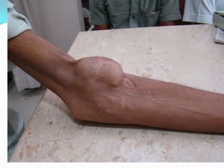 CARDIAC FAILURE
 OVER FUNCTIONING OF FISTULA
 PROXIMAL FISTULA
 LARGE ANASTOMOSIS
 REMEDY – CLOSURE OF FISTULA
 