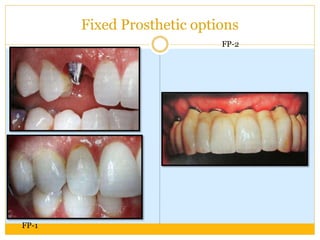 Fixed Prosthetic options
FP-1
FP-2
 
