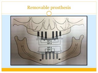 Removable prosthesis
 