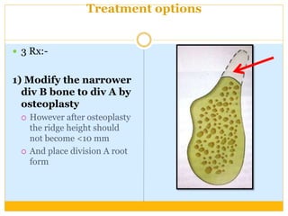 Treatment options
 3 Rx:-
1) Modify the narrower
div B bone to div A by
osteoplasty
 However after osteoplasty
the ridge height should
not become <10 mm
 And place division A root
form
 