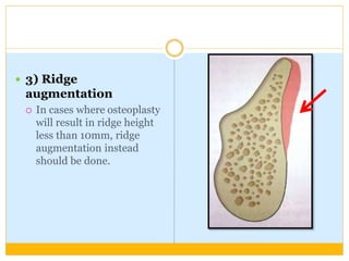  3) Ridge
augmentation
 In cases where osteoplasty
will result in ridge height
less than 10mm, ridge
augmentation instead
should be done.
 