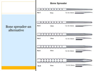 Bone spreader-an
alternative
 