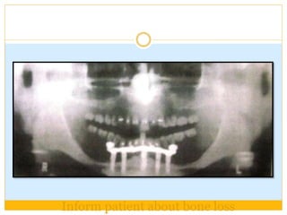 Inform patient about bone loss
 