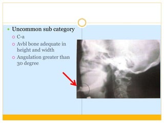  Uncommon sub category
 C-a
 Avbl bone adequate in
height and width
 Angulation greater than
30 degree
 