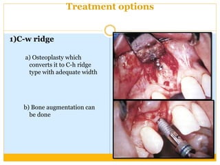 Treatment options
1)C-w ridge
a) Osteoplasty which
converts it to C-h ridge
type with adequate width
b) Bone augmentation can
be done
 