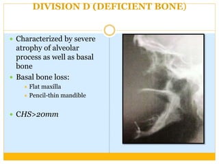 DIVISION D (DEFICIENT BONE)
 Characterized by severe
atrophy of alveolar
process as well as basal
bone
 Basal bone loss:
 Flat maxilla
 Pencil-thin mandible
 CHS>20mm
 