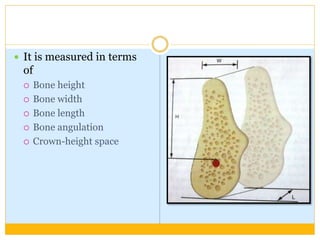  It is measured in terms
of
 Bone height
 Bone width
 Bone length
 Bone angulation
 Crown-height space
 