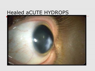 Healed aCUTE HYDROPS
 