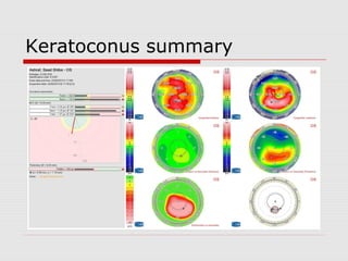 Keratoconus summary
 