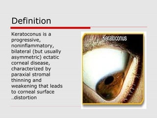 Definition
Keratoconus is a
progressive,
noninflammatory,
bilateral (but usually
asymmetric) ectatic
corneal disease,
characterized by
paraxial stromal
thinning and
weakening that leads
to corneal surface
distortion..
 