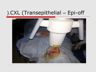 CXL (Transepithelial – Epi-off(.
 