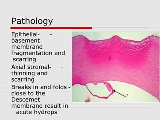 Pathology
--Epithelial
basement
membrane
fragmentation and
scarring
--Axial stromal
thinning and
scarring
-Breaks in and folds
close to the
Descemet
membrane result in
acute hydrops
 