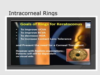 Intracorneal Rings
 